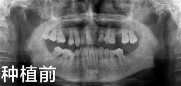成都华圣艺口腔种植牙前