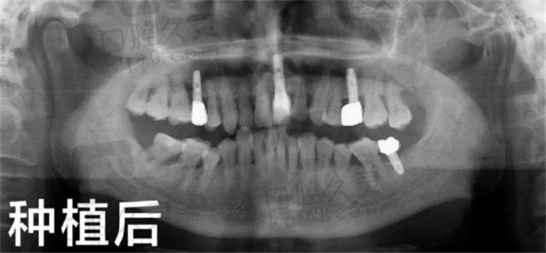 成都华圣艺口腔种植牙后