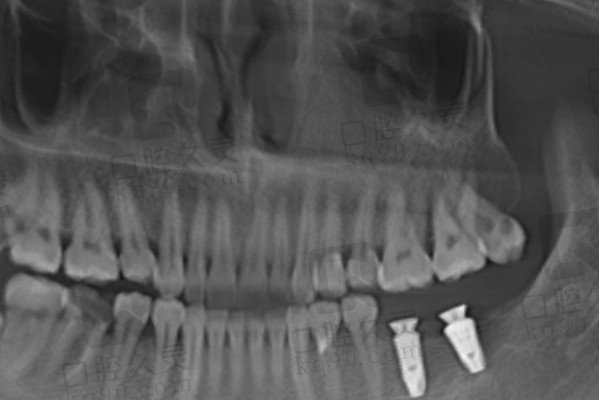 深圳博爱曙光医院种植牙后