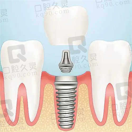 珠海九龙口腔医院种植牙
