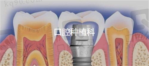 北京协和口腔科种植牙