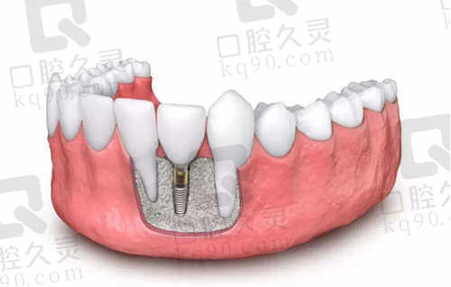 河南商丘京德口腔医院种植牙