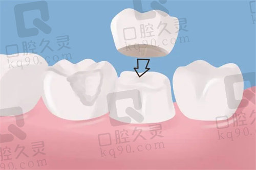 肇庆国美口腔医院牙冠贵不贵?