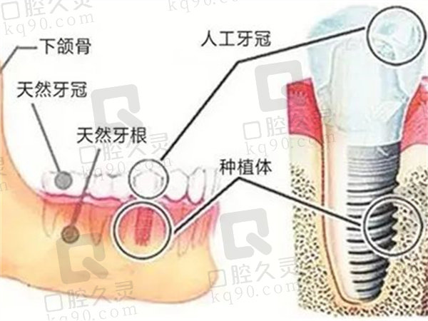 秦皇岛口腔医院种植牙技术怎么样