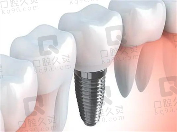 秦皇岛口腔医院种植牙技术怎么样