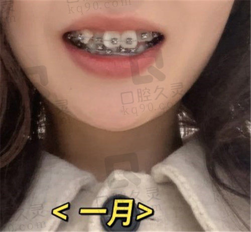 成都马泷齿科矫正牙1个月后