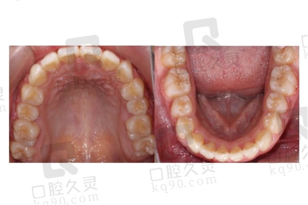 深圳慈恩齿科侯宪昂医生舌侧矫正后
