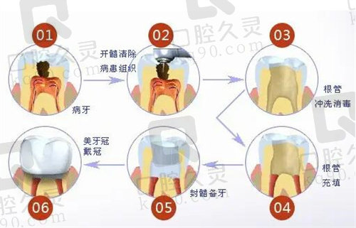 泗阳明润口腔根管治疗