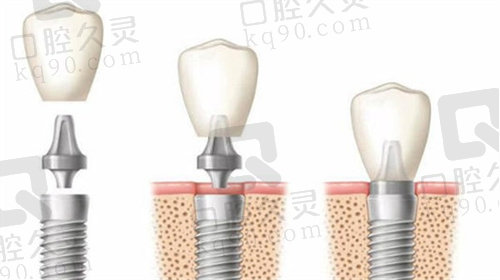 漳州呀哚口腔种植牙价格表
