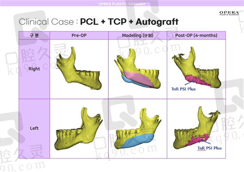 韩国欧佩拉下颌角补骨过程