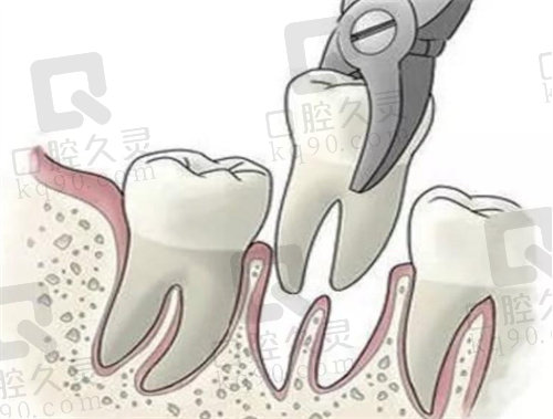 浙江大学医学院附属口腔医院拔牙价格
