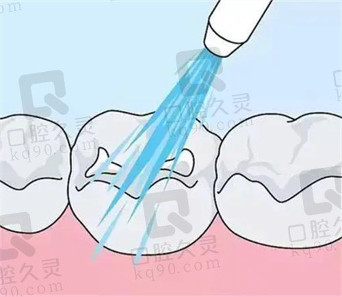 广安爱牙仕口腔洗牙价格表