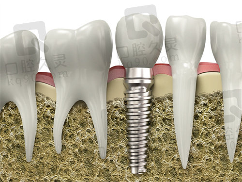 广安爱牙仕口腔种植牙价格表