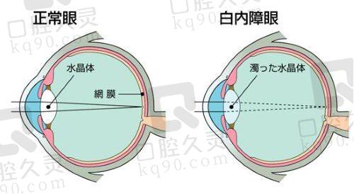 西安医大眼科医院激光近视手术