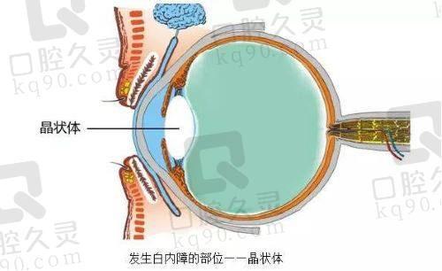 西安医大眼科医院激光近视手术