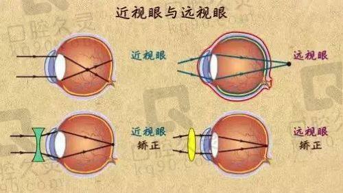 西安医大眼科医院激光近视手术