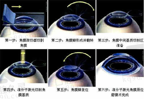 武汉普瑞眼科医院手术项目