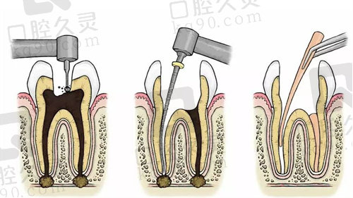 浙医二院口腔科根管治疗好不好