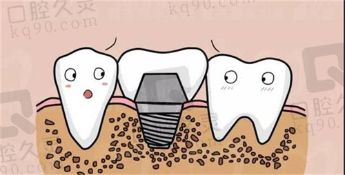 杭州英博口腔医院种植牙价格