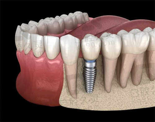 武汉大众口腔医院种植牙
