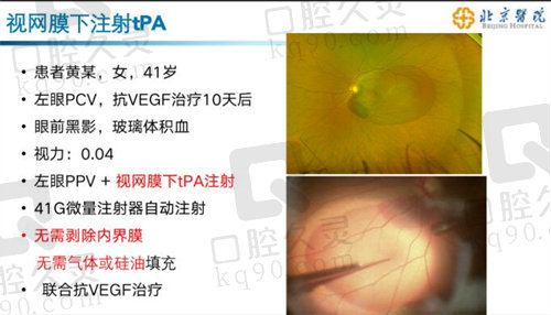 北京医院眼科视网膜注射