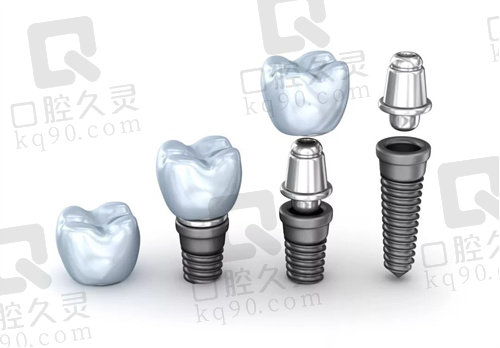 杭州植成口腔医院种植牙价格表