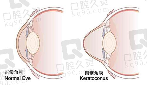 上海和平眼科医院做角膜交联手术的优势