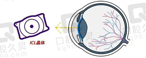 杭州爱尔眼科医院ICL植入手术的价格