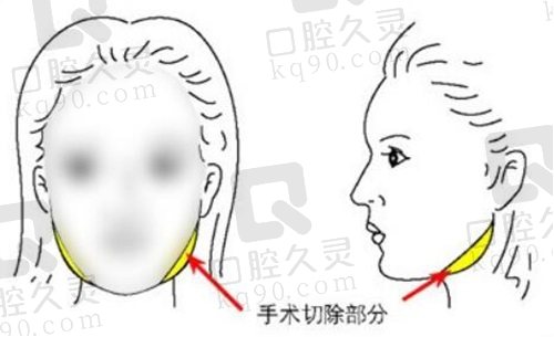 上海九 院下颌角整形术后口碑反馈