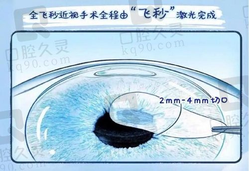 上海爱尔眼科医院全飞秒近视矫正手术