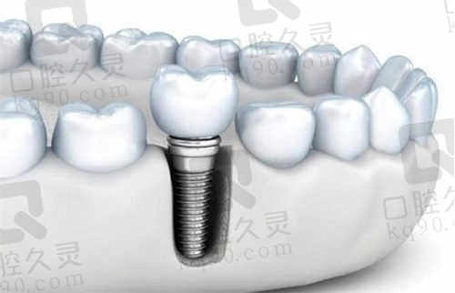 重庆团圆口腔医院种植牙价格