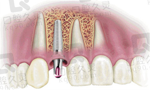 湖州金铂利口腔种植牙价格