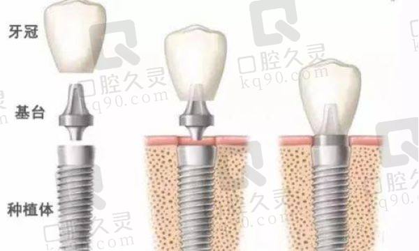 成都中诺口腔种牙多少钱