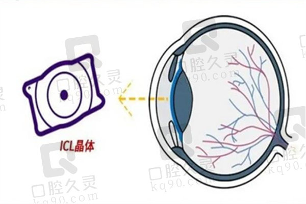 ICL晶体植入术