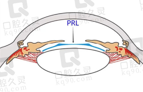 PRL晶体植入