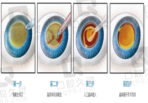 白内障手术图