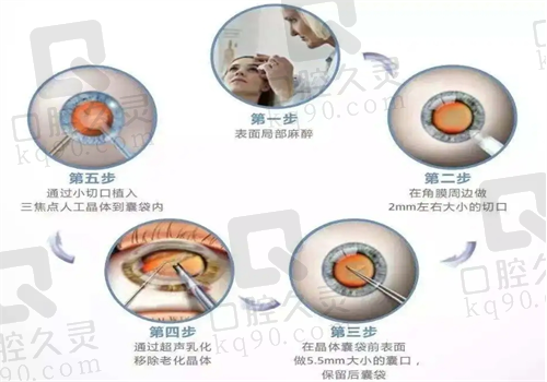 白内障手术图