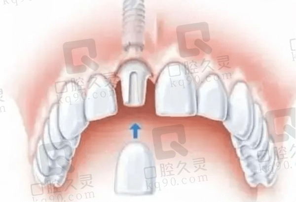 珠海诺贝尔口腔种植牙医生怎么样