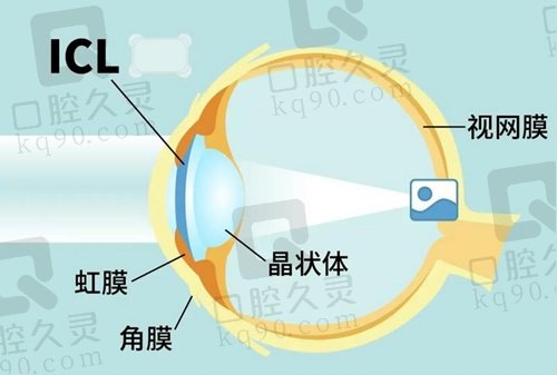 上海和平眼科医院ICL晶体植入近视矫正术