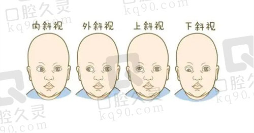 北京熙仁眼科儿童斜视情况