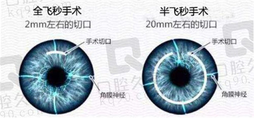 北京爱仁眼科全飞秒半飞秒