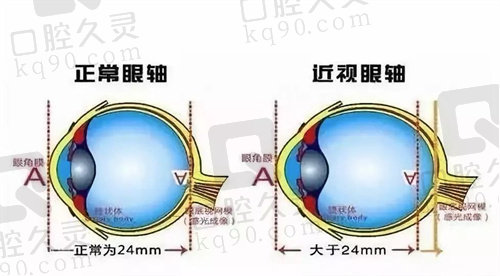 杭州华厦眼科医院近视手术