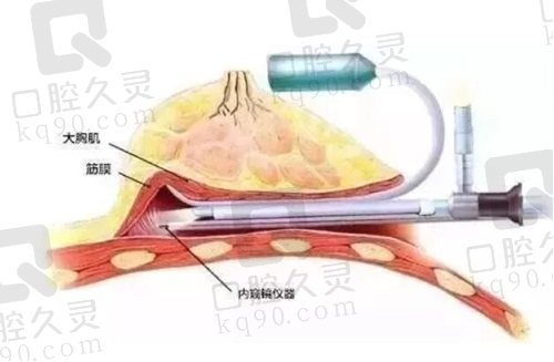 上海谢卫国医生下皱襞假体隆胸术