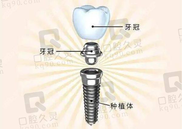 珠海六和口腔医院美国皓圣种植牙多少钱