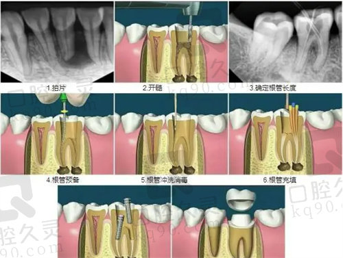 根管治疗和杀牙神经是一回事吗