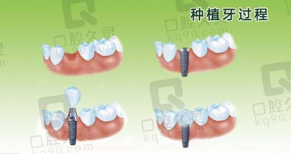 咸阳海涛口腔医院韩国DIC种植牙多少钱