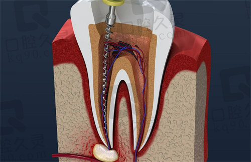 杭州根管治疗