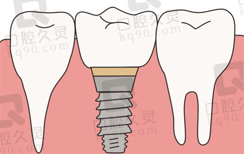 微创种植牙和普通种植牙区别