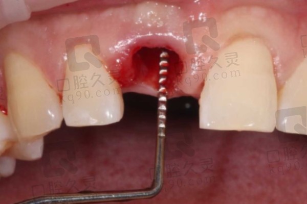 深圳正夫口腔医院种植牙过程