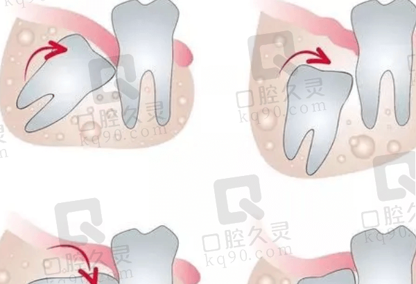 拔智齿术后注意事项